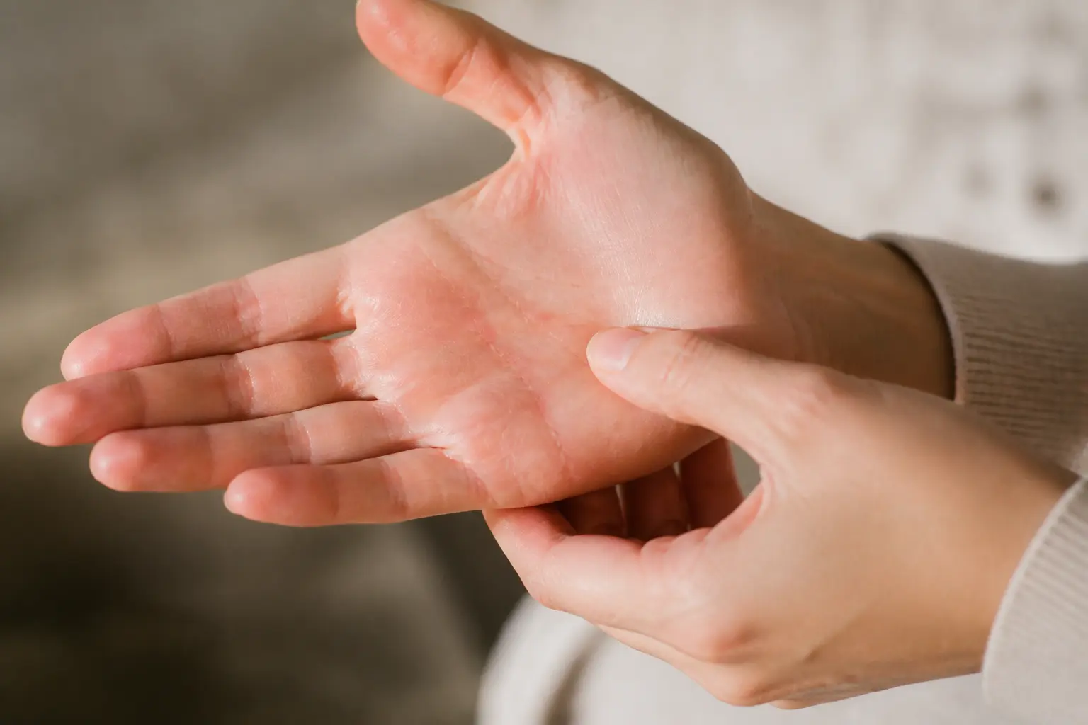 Main gauche qui gratte, paume irritée examinée de près, légère rougeur et peau sèche sur fond flou naturel