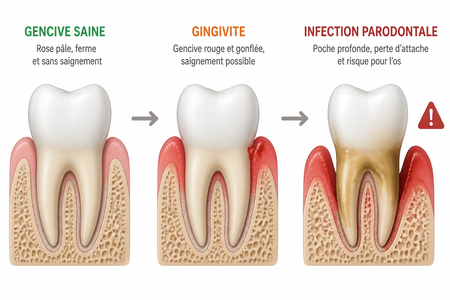 Gingivite traitement naturel : comparaison d’une gencive saine, d’une gingivite et d’un problème plus sérieux